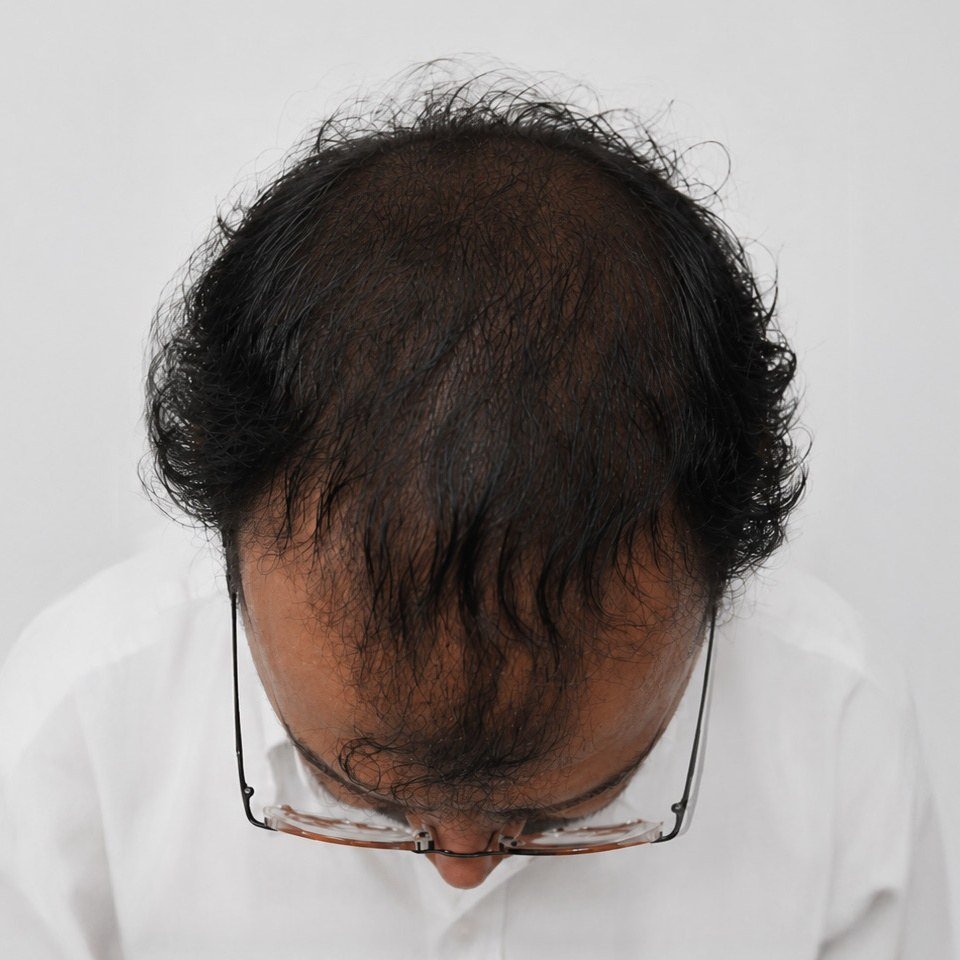 Post Treatment Hair Density Restoration